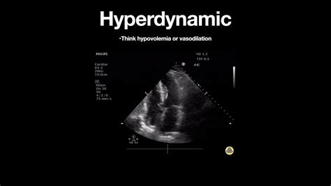 hyperdynamic left ventricle meaning.